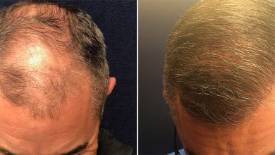 FUE Hair Transplant: Does it Last Forever?