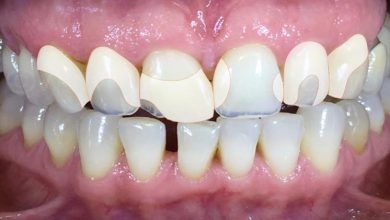 5 Advantages Of Combining Teeth Whitening With Restorations