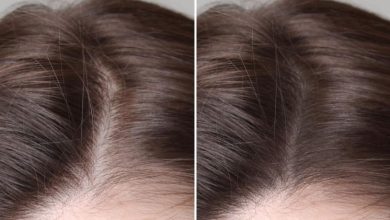 Hair Regrowth Treatment Singapore How Early Should You Start