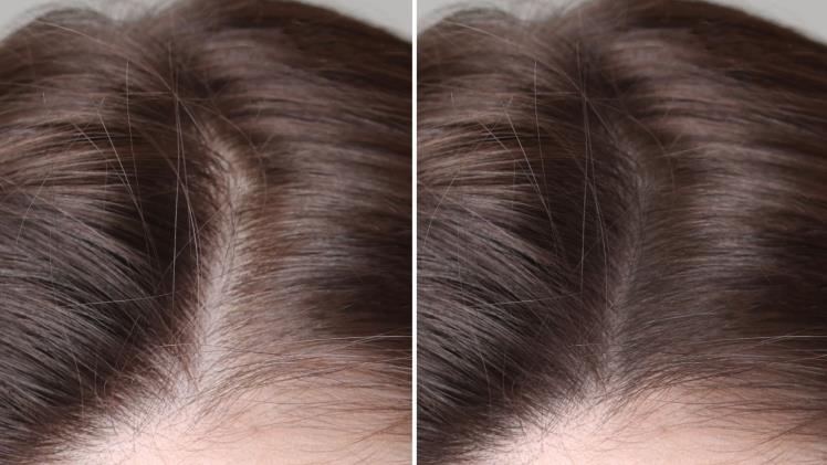 Hair Regrowth Treatment Singapore How Early Should You Start